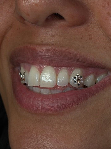 Close-up smile with tooth gems applied